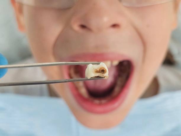 Best Broken or Chipped Tooth Repair in Standish, MI